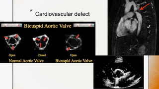 z
Cardiovascular defect
 