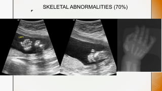 z
SKELETAL ABNORMALITIES (70%)
 