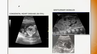 z
CONGENITAL HEART DISEASE (50-70%)
GENITOURINARY ANOMALIES
 