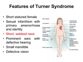 Features of Turner Syndrome
• Short statured female
• Sexual infantilism with
primary amenorrhoea
and sterility
• Short, webbed neck
• Prominent ears with
defective hearing
• Small mandible
• Defective vision
 