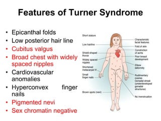 Features of Turner Syndrome
• Epicanthal folds
• Low posterior hair line
• Cubitus valgus
• Broad chest with widely
spaced nipples
• Cardiovascular
anomalies
• Hyperconvex finger
nails
• Pigmented nevi
• Sex chromatin negative
 