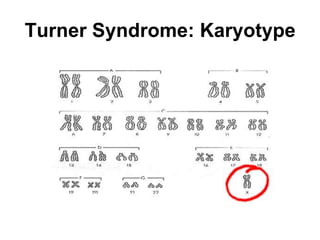 Turner Syndrome: Karyotype
 