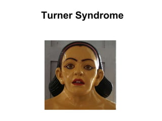 Turner Syndrome
 