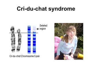 Cri-du-chat syndrome
 
