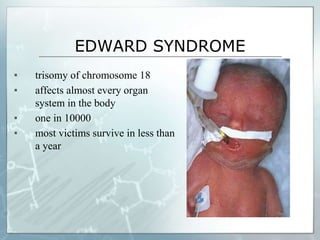 EDWARD SYNDROME
▪ trisomy of chromosome 18
▪ affects almost every organ
system in the body
▪ one in 10000
▪ most victims survive in less than
a year
 