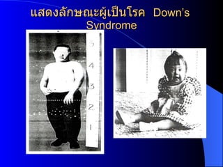 Chromosomal disorder[1]
