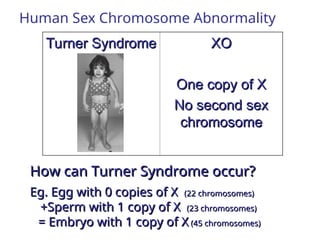 Xo Chromosome Abnormality Is