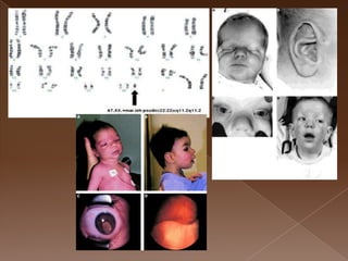 Chromosomal Abnormalities Facial Features