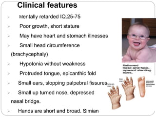 Clinical features
 Mentally retarded IQ.25-75
 Poor growth, short stature
 May have heart and stomach illnesses
 Small head circumference
(brachycephaly)
 Hypotonia without weakness
 Protruded tongue, epicanthic fold
 Small ears, slopping palpebral fissures
 Small up turned nose, depressed
nasal bridge.
 Hands are short and broad. Simian
 