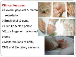 Clinical features
Severe physical & mental
retardation
Small skull & eyes.
Cleft lip & cleft palate
Extra finger or malformed
thumb
Malformations of CVS,
CNS and Excretory systems
 