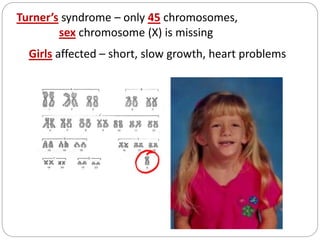 Turner’s syndrome – only 45 chromosomes,
sex chromosome (X) is missing
Girls affected – short, slow growth, heart problems
 