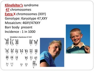 Klinefelter’s syndrome
47 chromosomes
Extra X chromosomes (XXY)
Genotype: Karyotype 47,XXY
Mosaicism: 46XY/47XXY
Barr body present
Incidence : 1 in 1000
 