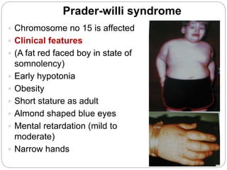 Prader-willi syndrome
 Chromosome no 15 is affected
 Clinical features
 (A fat red faced boy in state of
somnolency)
 Early hypotonia
 Obesity
 Short stature as adult
 Almond shaped blue eyes
 Mental retardation (mild to
moderate)
 Narrow hands
 