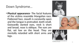 Down Syndrome…
• Physical appearance- The facial features
of the victims resemble Mangolian race.
Flattened face, mouth is constantly open
and the tongue is protruded, teeth small.
Outwardly slanted eyes, neck is short
and broad, nose is oblique. The ears are
flat, set low on the head. They are
mentally retarded with short arms and
legs.
60
 