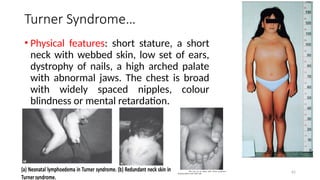 Turner Syndrome…
• Physical features: short stature, a short
neck with webbed skin, low set of ears,
dystrophy of nails, a high arched palate
with abnormal jaws. The chest is broad
with widely spaced nipples, colour
blindness or mental retardation.
62
 