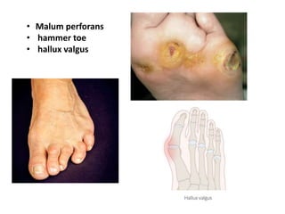 • Malum perforans
• hammer toe
• hallux valgus
 