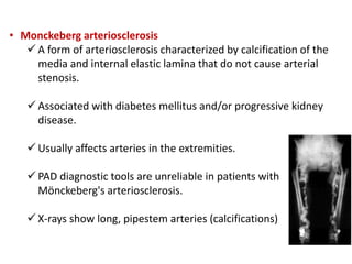 • Monckeberg arteriosclerosis
 A form of arteriosclerosis characterized by calcification of the
media and internal elastic lamina that do not cause arterial
stenosis.
 Associated with diabetes mellitus and/or progressive kidney
disease.
 Usually affects arteries in the extremities.
 PAD diagnostic tools are unreliable in patients with
Mönckeberg's arteriosclerosis.
 X-rays show long, pipestem arteries (calcifications)
 