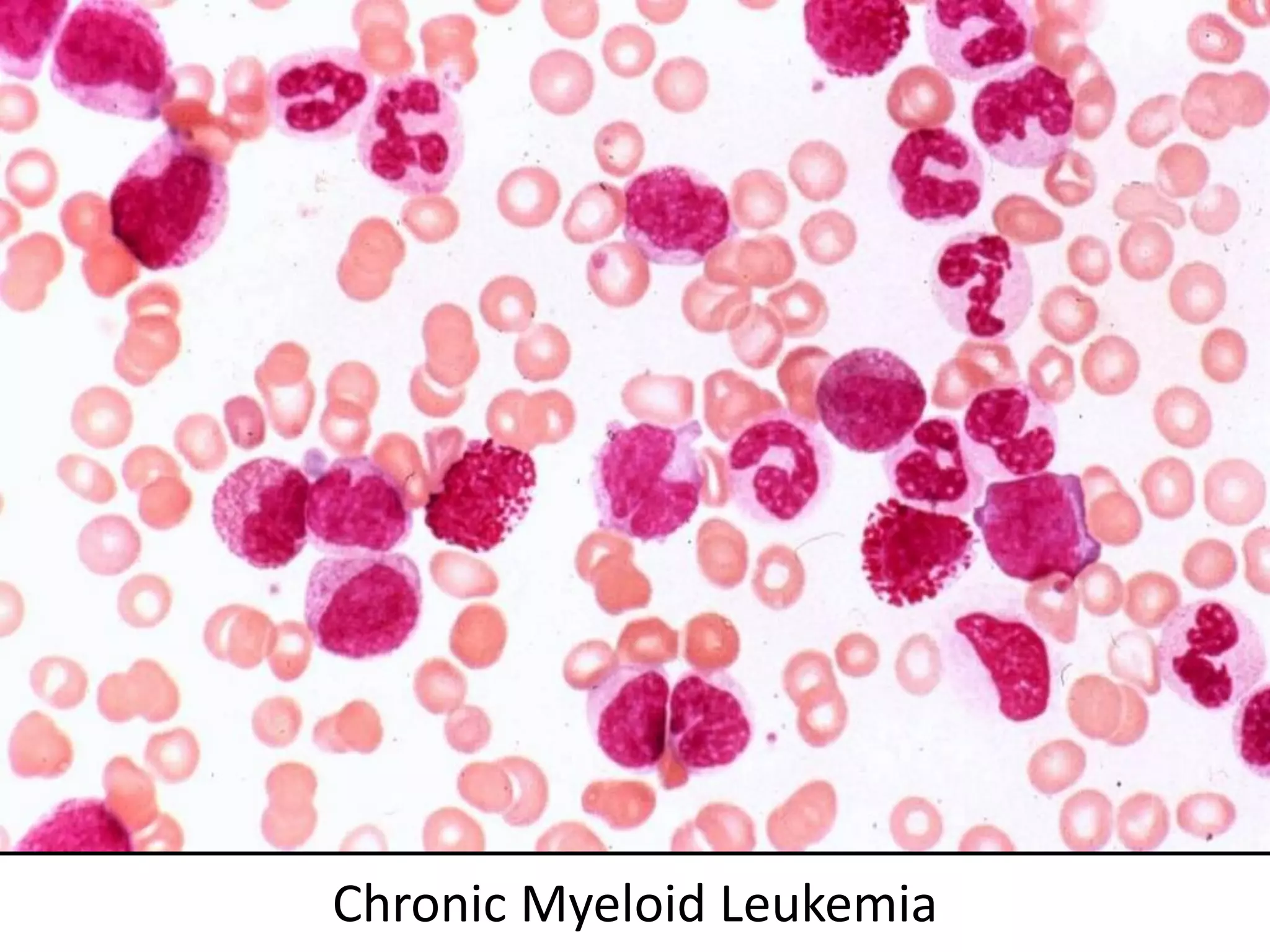 Chronic Myeloid Leukemia
 