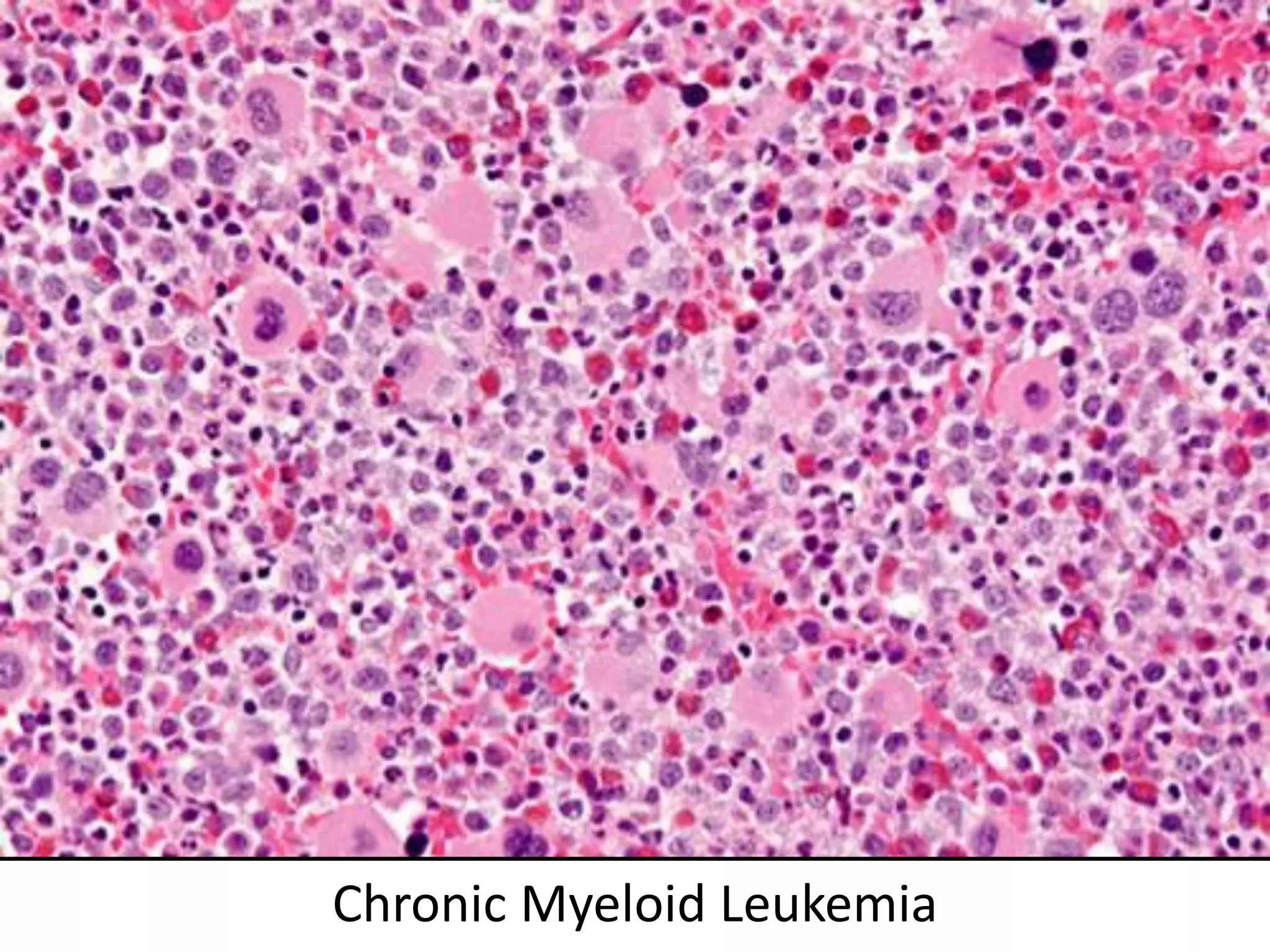 Chronic Myeloid Leukemia
 