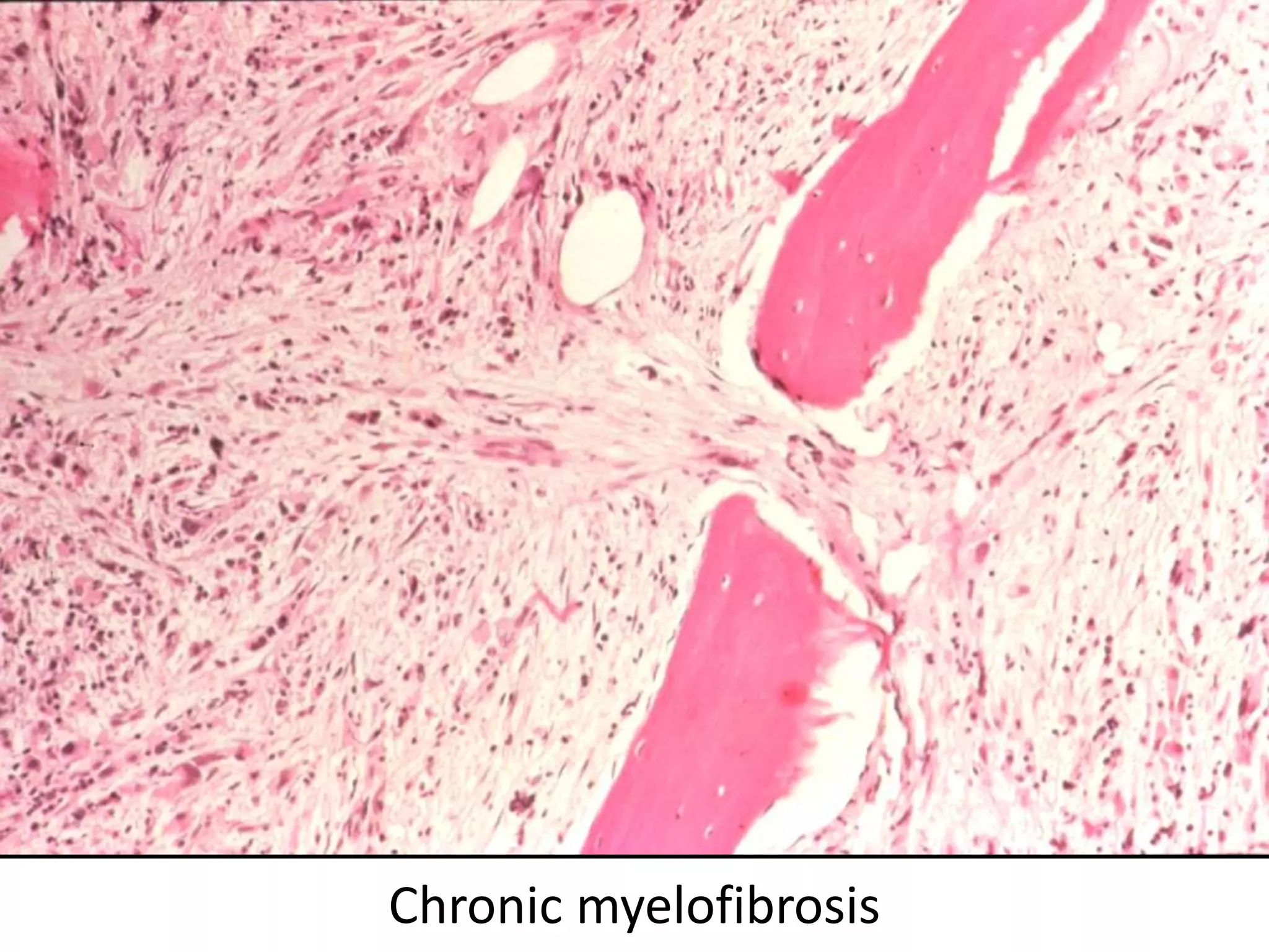 Chronic myelofibrosis
 