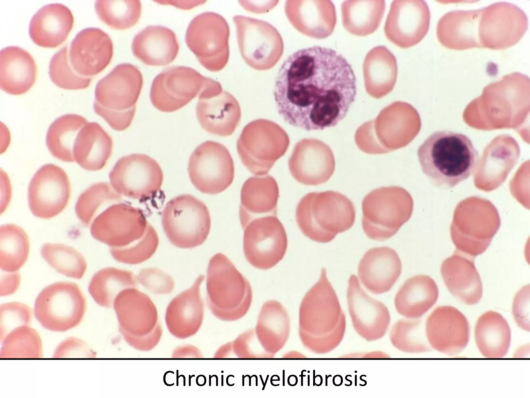 Chronic myelofibrosis
 