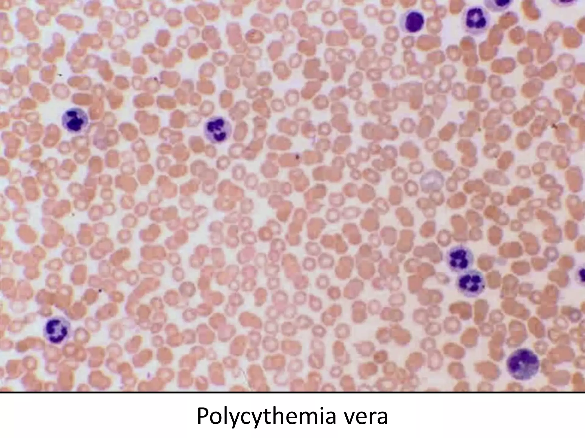 Polycythemia vera
 