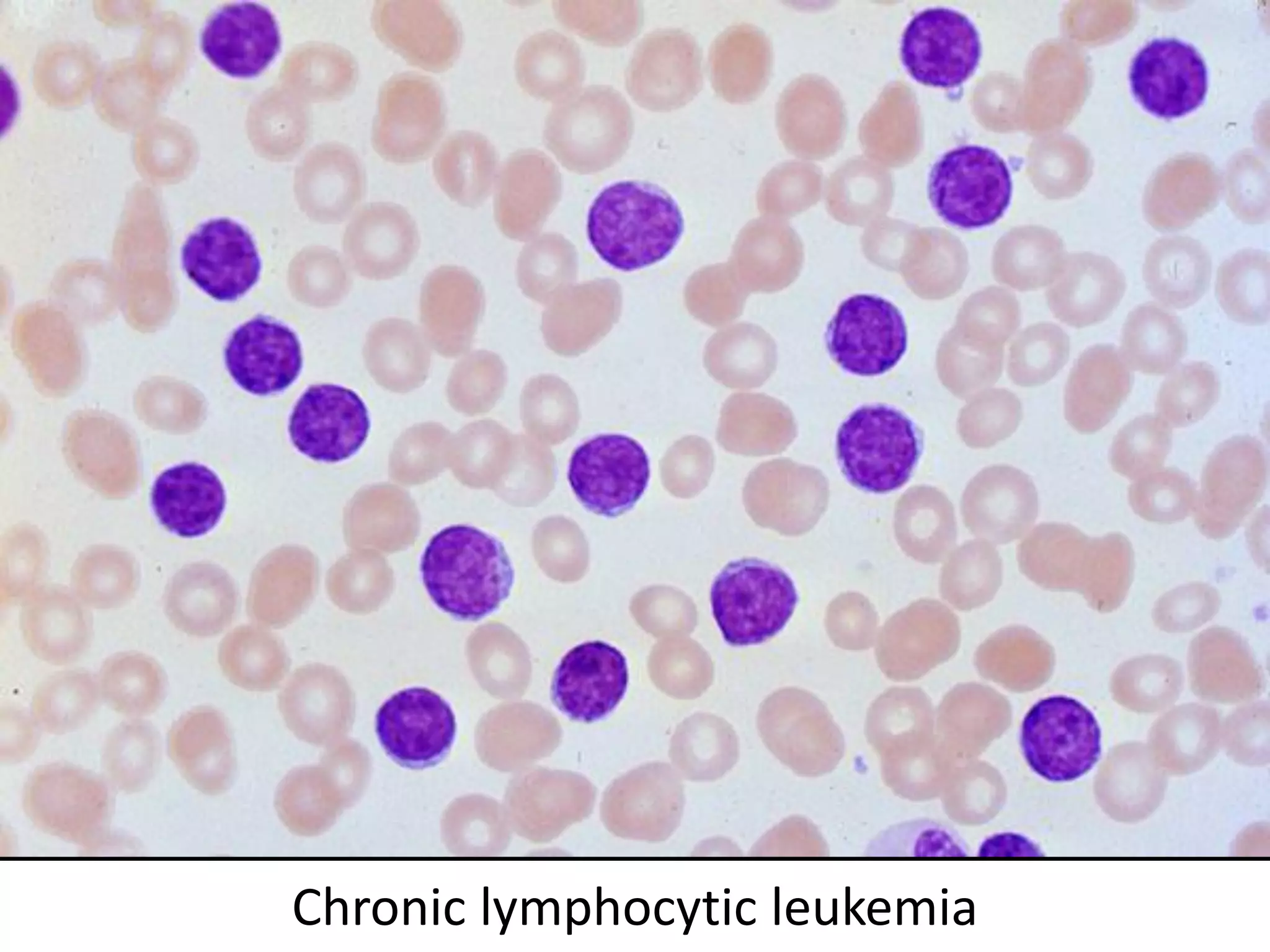 Chronic lymphocytic leukemia
 