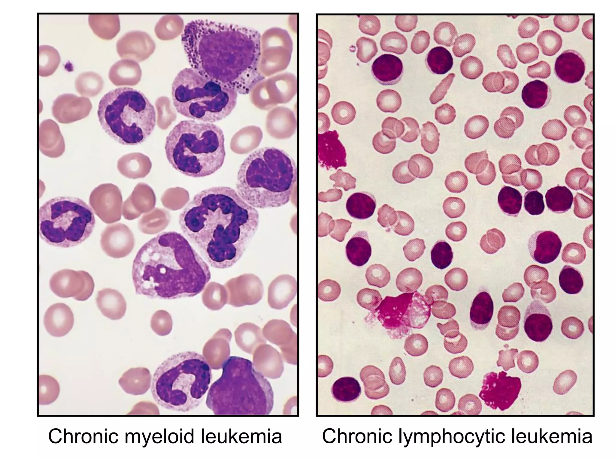 Chronic myeloid leukemia Chronic lymphocytic leukemia
 