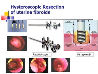 Chronic Pelvic Pain | PPT