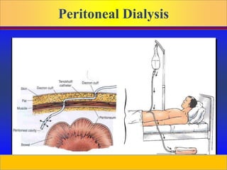 Prepared by D. Chaplin
Peritoneal Dialysis
 