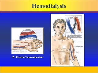 Prepared by D. Chaplin
Hemodialysis
AV Fistula Communication
AV Graph Access
 