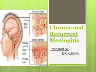 Chronic and
Recurrent
Meningitis
Prepared By:
       DR.KUCHA
 