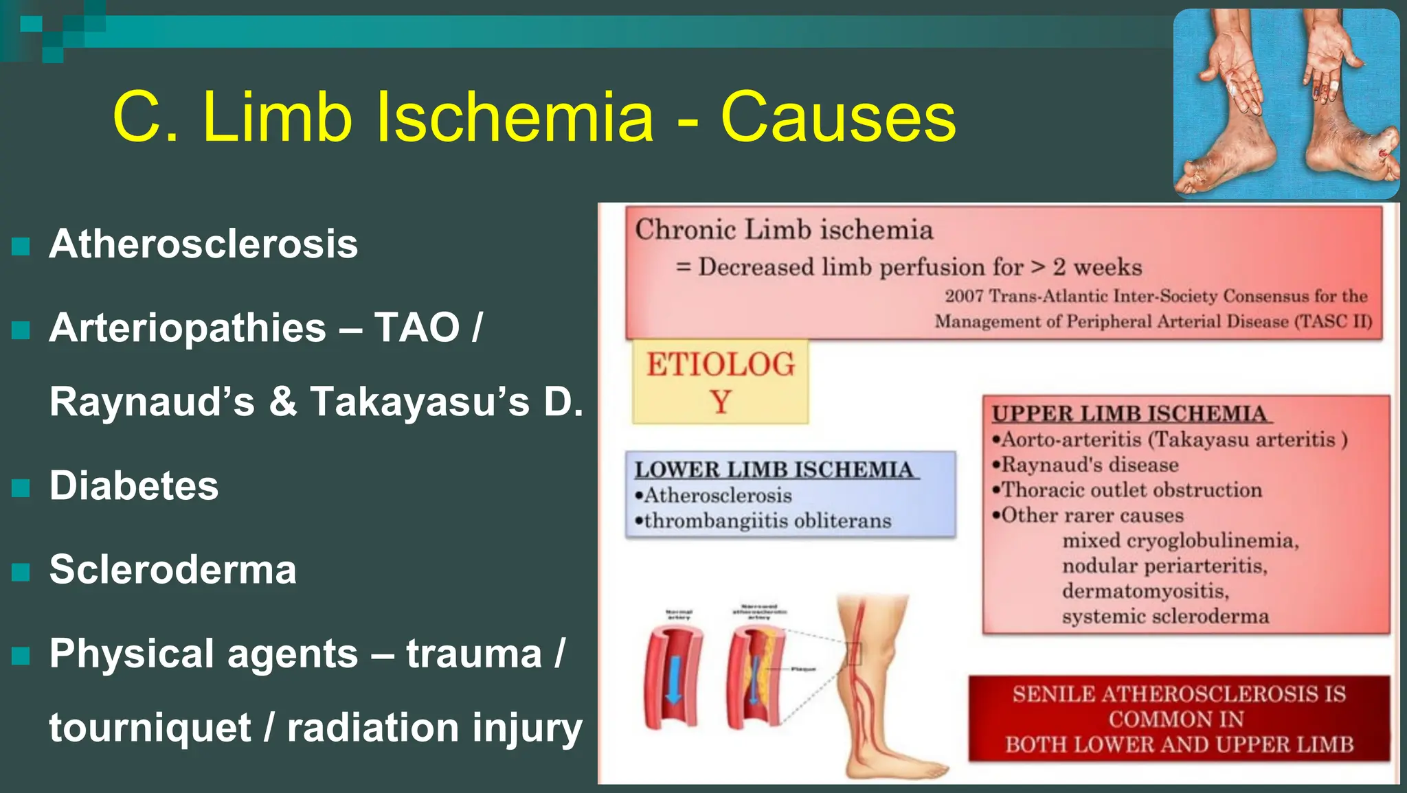 Chronic Arterial Diseases - Chronic Limb Ischemia | PDF