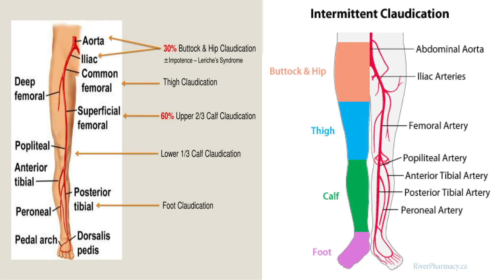 Chronic Arterial Diseases - Chronic Limb Ischemia | PDF