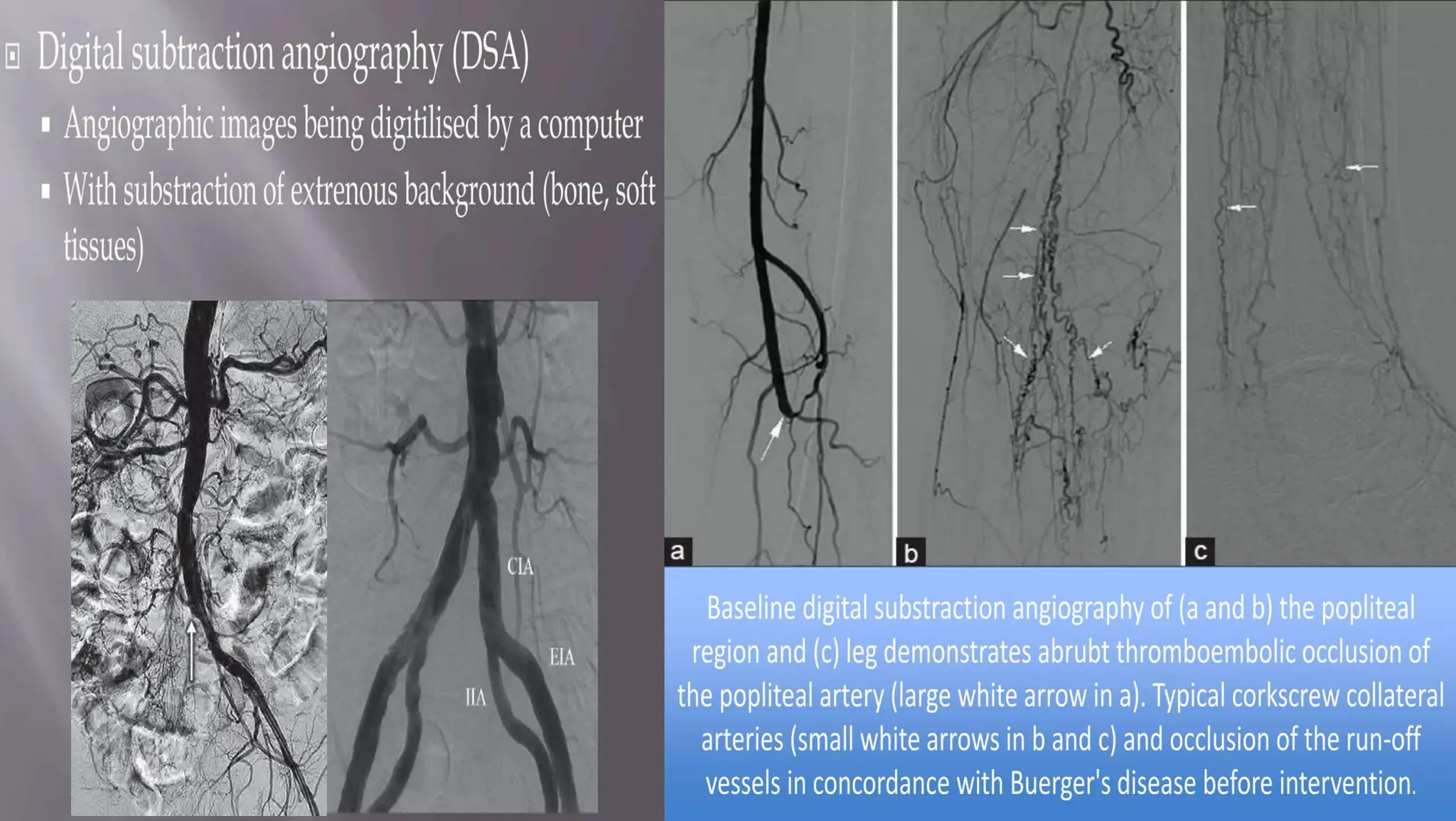 Chronic Arterial Diseases - Chronic Limb Ischemia | PDF