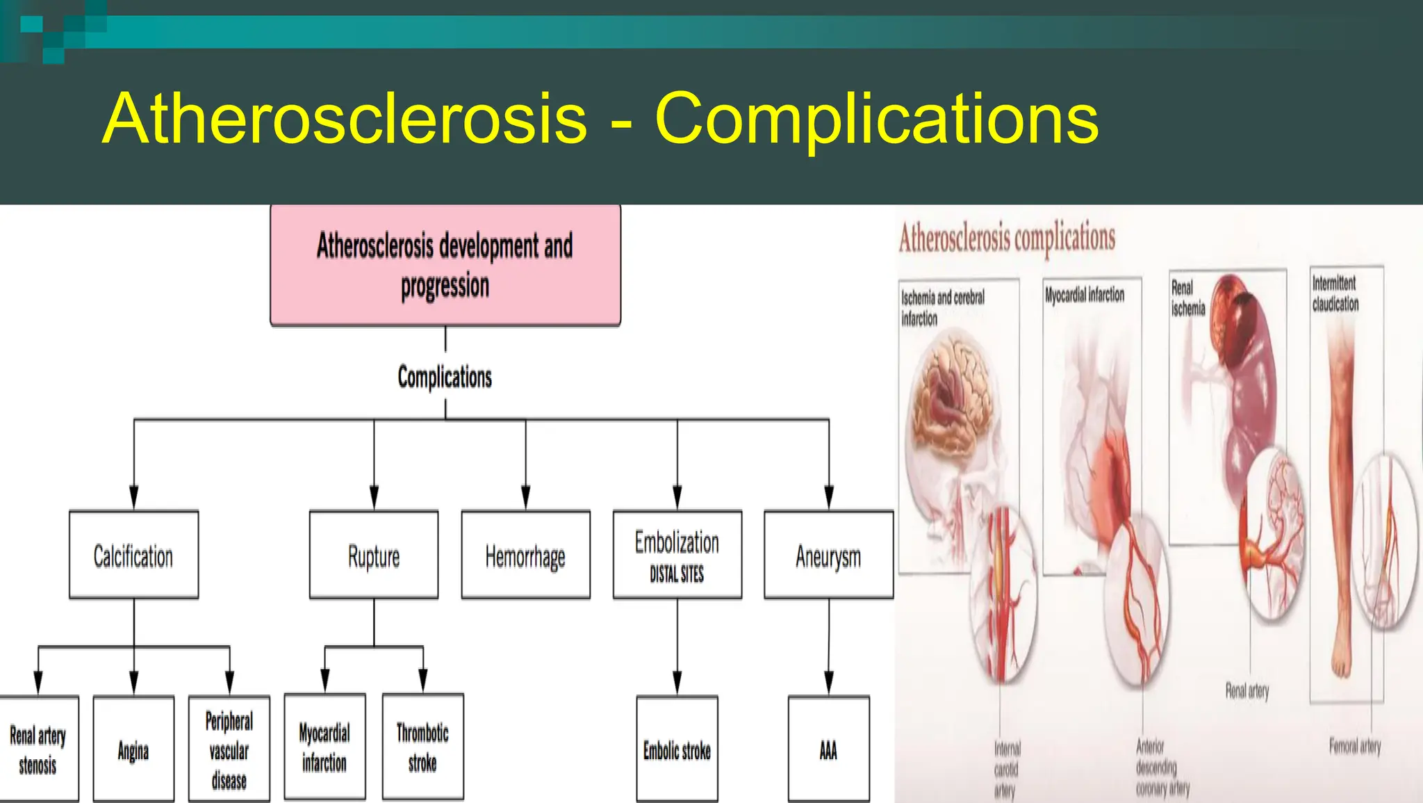 Chronic Arterial Diseases - Chronic Limb Ischemia | PDF