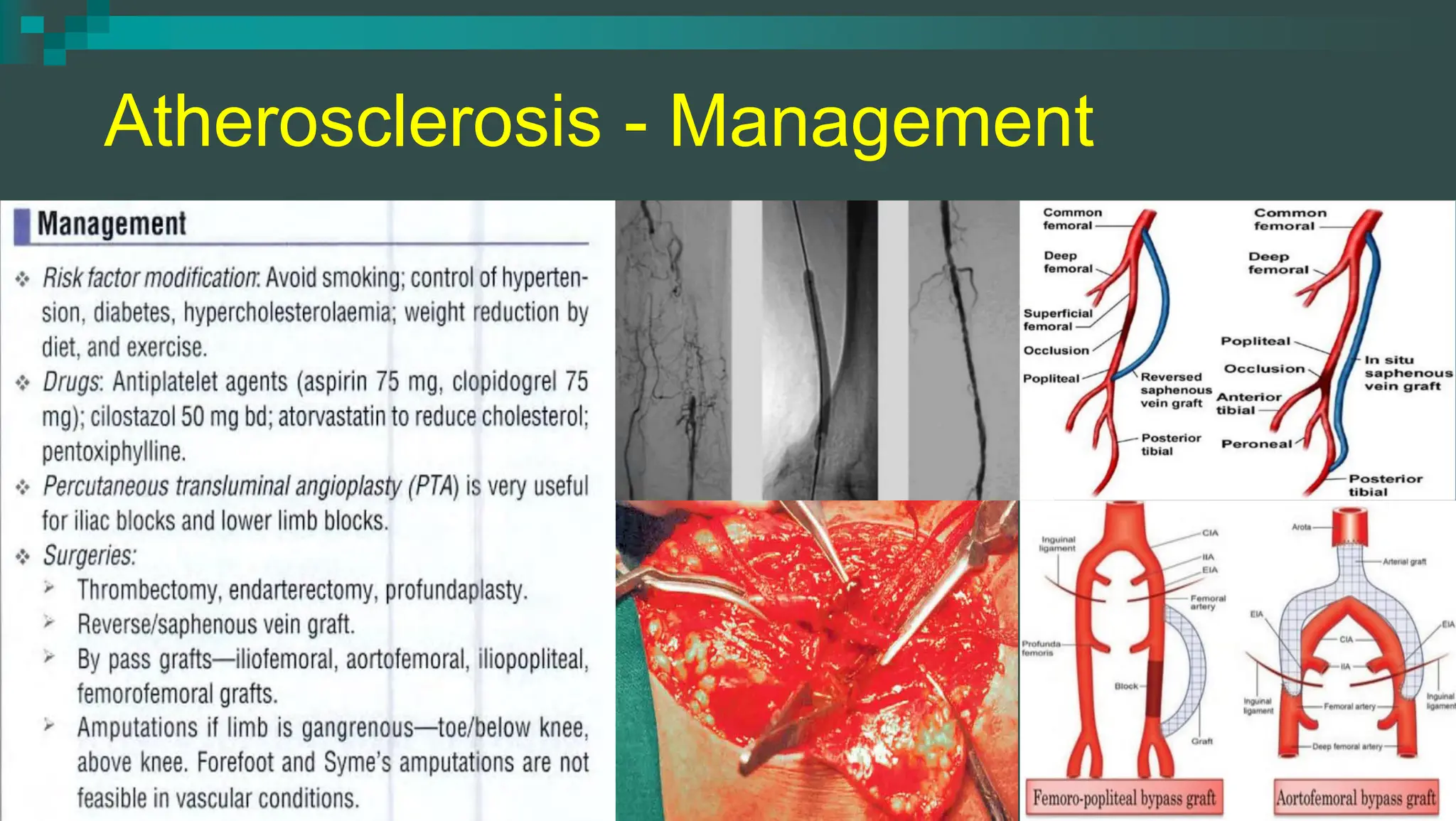 Chronic Arterial Diseases - Chronic Limb Ischemia | PDF
