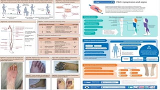 Chronic Arterial Diseases - Chronic Limb Ischemia | PDF