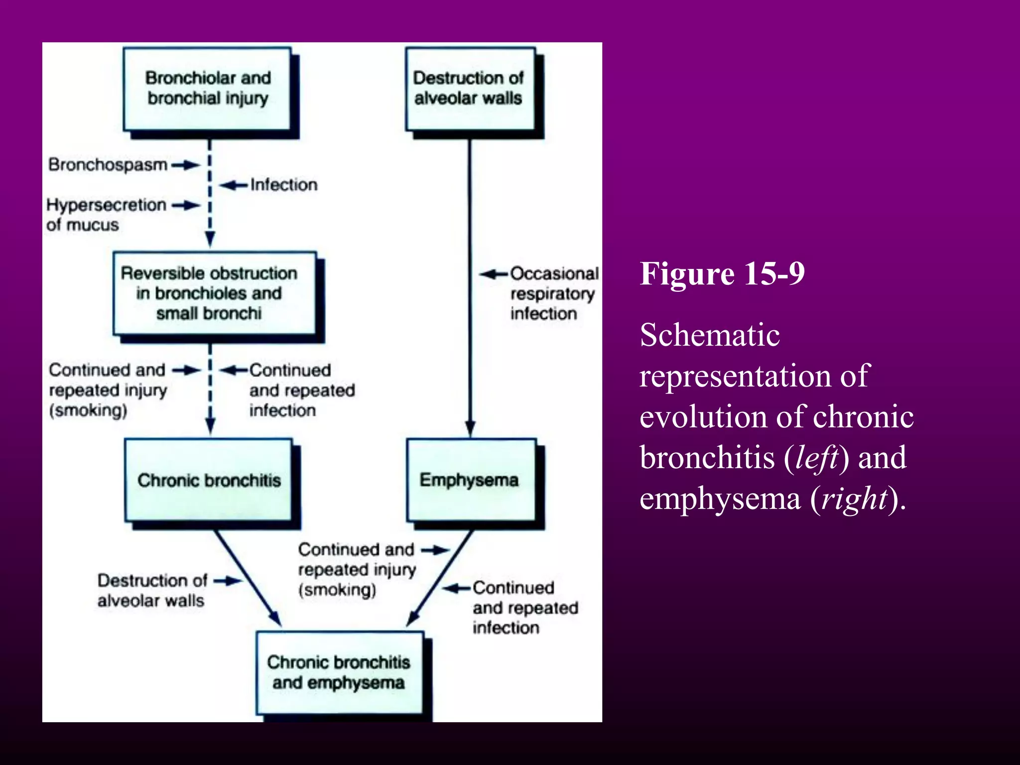 Chronic bronchitis | PDF