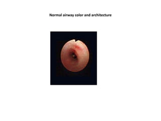 Normal airway color and architecture
 
