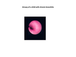 Airway of a child with chronic bronchitis
 