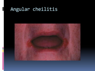 Chronic candidiasis | PPTX