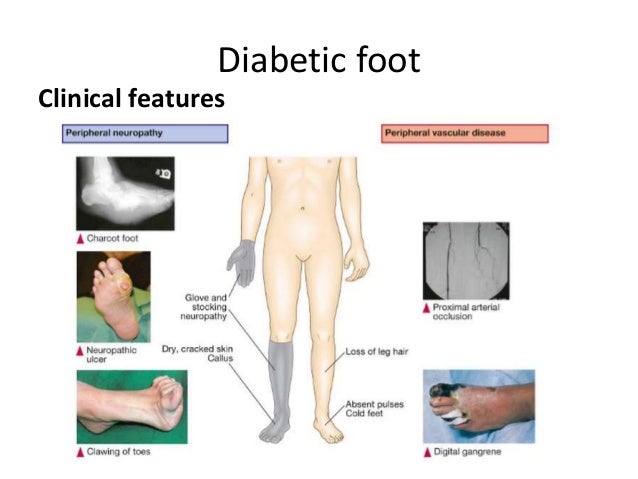 Diabetes Hair Loss On Legs
