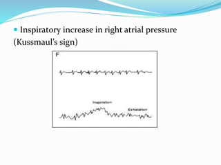  Inspiratory increase in right atrial pressure
(Kussmaul’s sign)
 