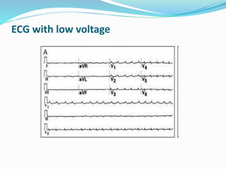 ECG with low voltage
 
