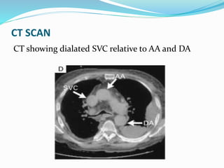 CT SCAN
CT showing dialated SVC relative to AA and DA
 