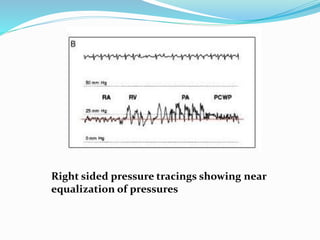 Right sided pressure tracings showing near
equalization of pressures
 