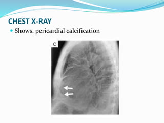 CHEST X-RAY
 Shows. pericardial calcification
 