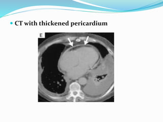  CT with thickened pericardium
 