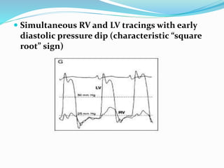  Simultaneous RV and LV tracings with early
diastolic pressure dip (characteristic “square
root” sign)
 